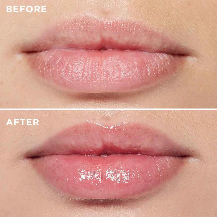 3D Lip Plumping Treatment - enara Wellness