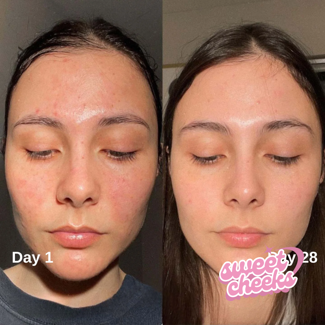 NIACINAMIDE + KOJIC ACID GLOW AND CORRECTIVE SERUM - Sweet Cheeks